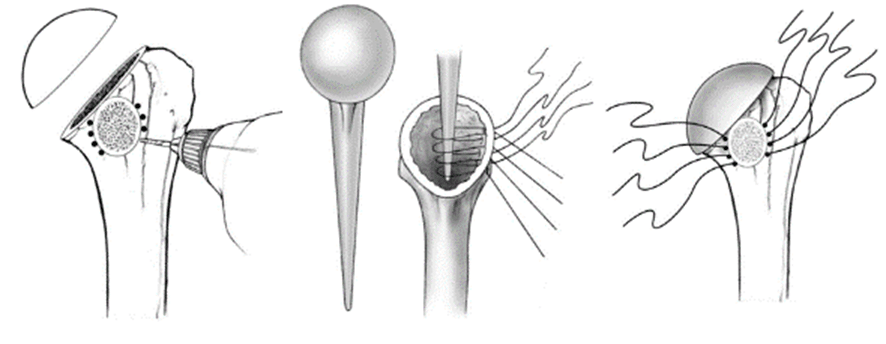 Systematic Review Of Lesser Tuberosity Osteotomy Techniques Outcomes