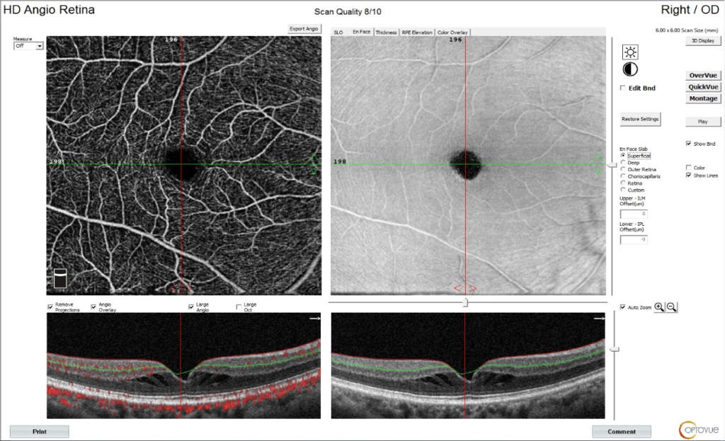 retinal capillary plexus