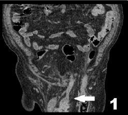 TC scan: Hernia