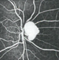 Fluorescein angiography