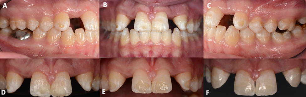 Pre-operative right lateral