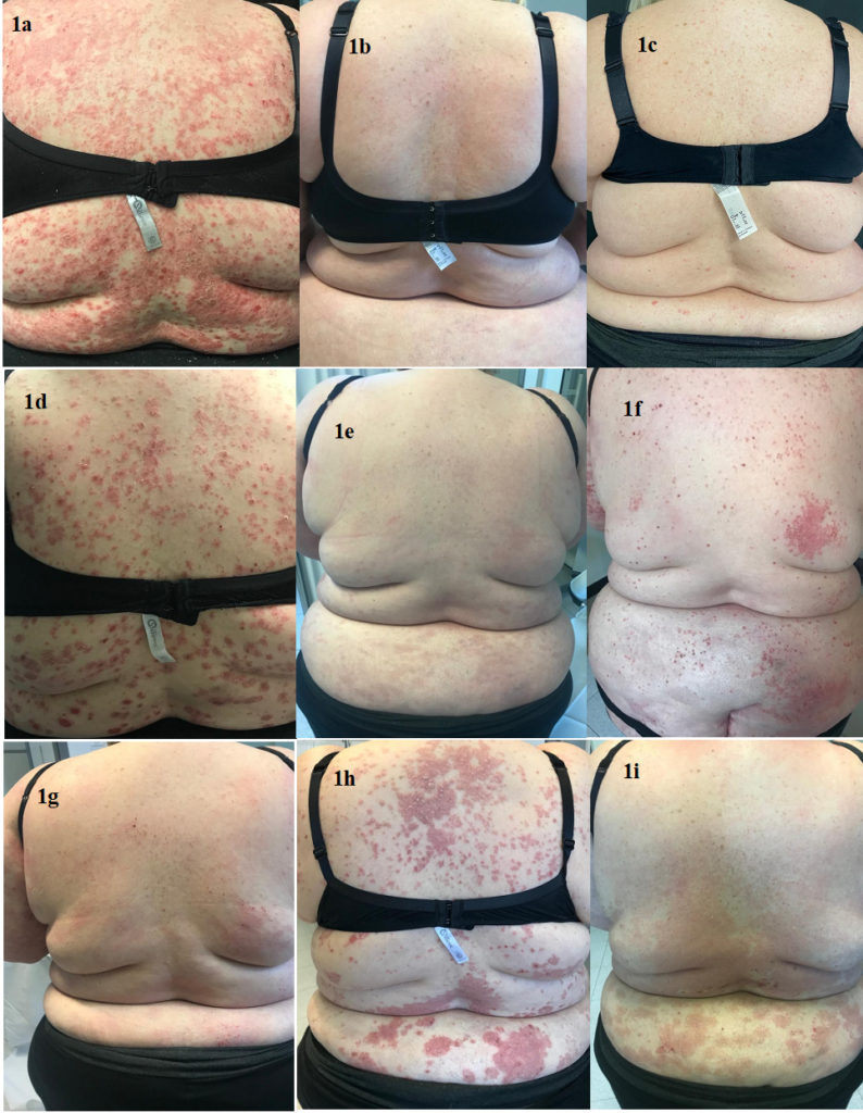 patient’s psoriasis