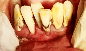 Chronic periodontitis