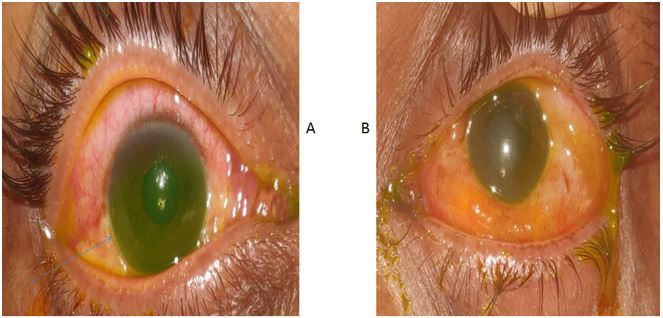 chemical ocular injury