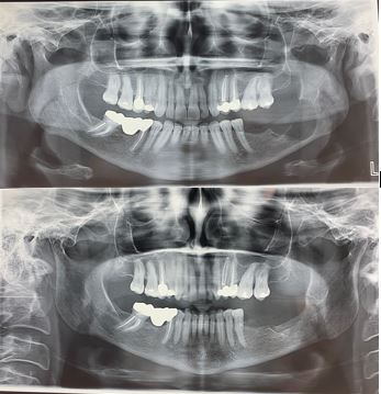 mandibular defect