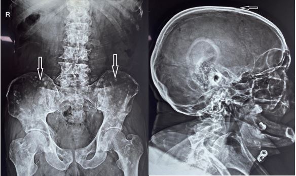 diffuse sclerotic metastatic