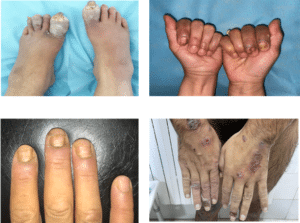 Figure 1: Images showing onychomadesis, Beau's lines, paronychia, and periungual bullae in pemphigus patients.