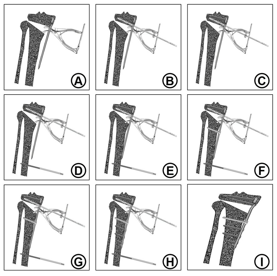 Medial Open-wedge High Tibial Osteotomy