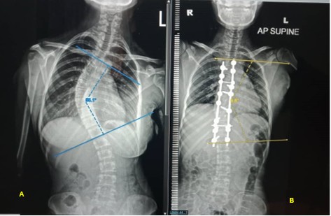 Improvement Of Life After Scoliosis Surgery: Assessment Using The SRS ...