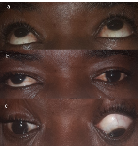 Surgical Treatment of a Large-Angle Post Traumatic Hypertropia by The ...