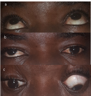 Surgical Treatment of a Large-Angle Post Traumatic Hypertropia by The ...