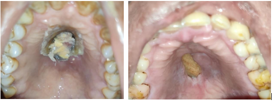 Palatal ulceration