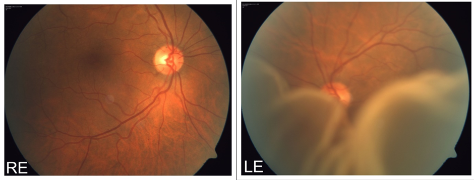 retinal detachment