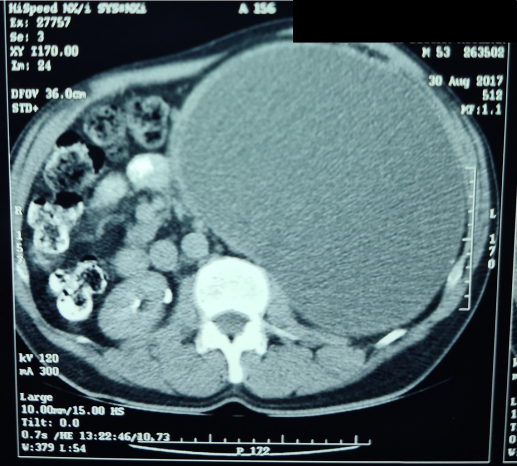 large cystic-like tumor