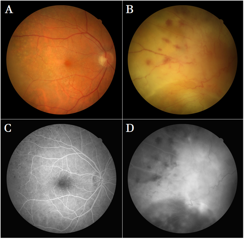 fluorescein angiography