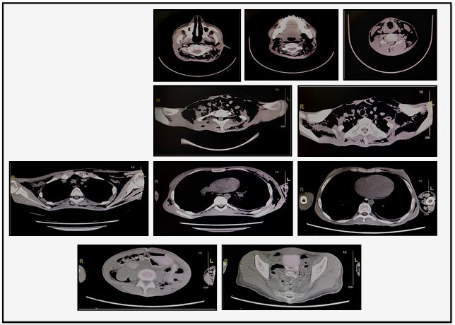 Axial slices of CT scan