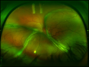 juxtapapillary retinal capillary haemangioma