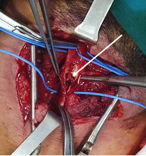 Longitudinal arteriotomy