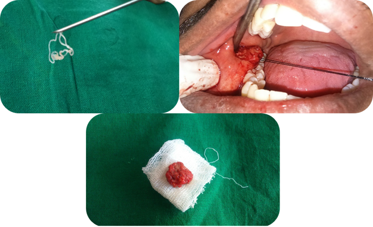 excised lesion