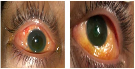 conjunctival involvement