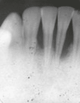 periodontitis