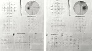 Perimetry of patient