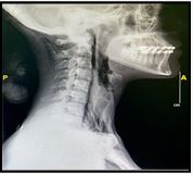 X-ray of cervical spine