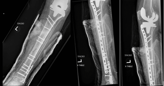 Retrograde Tibia Intramedullary Nailing in Tibiotalocalcaneal ...