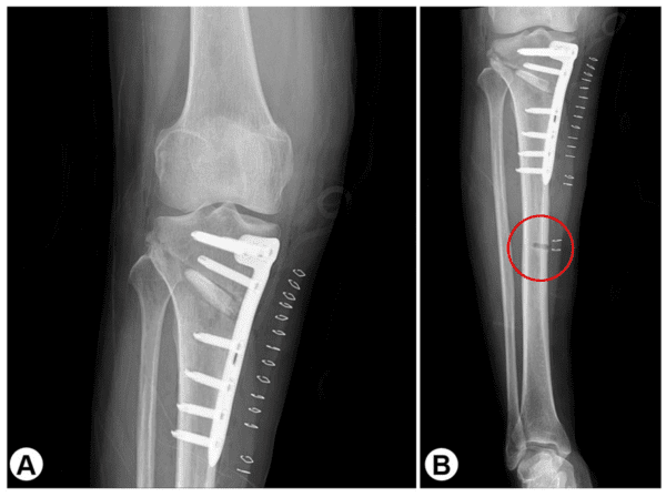Medial Open-wedge High Tibial Osteotomy