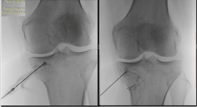 Case Of Successful Treatment Of A Patient With Subchondral Fracture Of The Knee Joint Using 9843