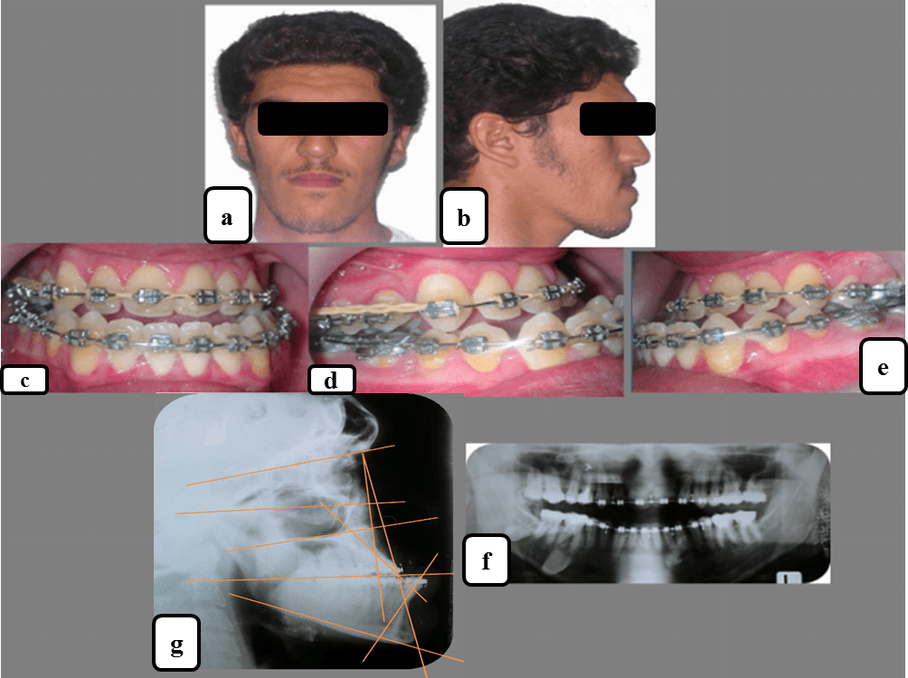 Orthodontic-Surgical Correction of a Skeletal