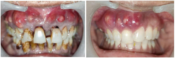 intra-oral sinus