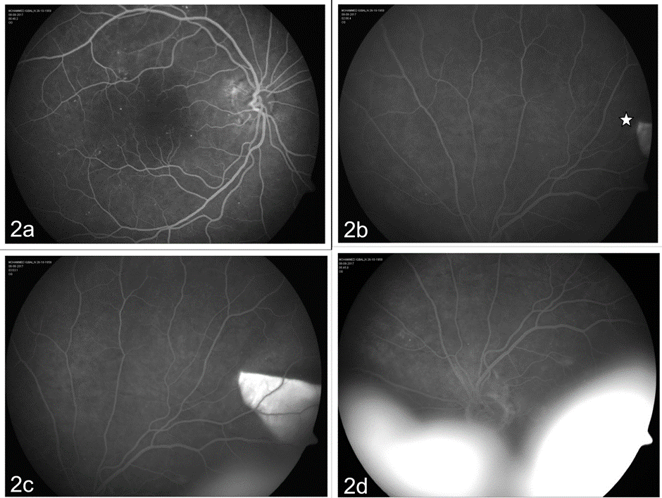 Fundus Fluorescein Angiogram