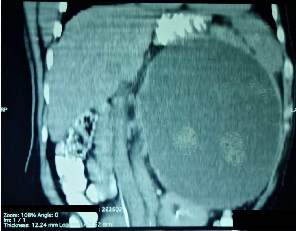 Coronal tomography