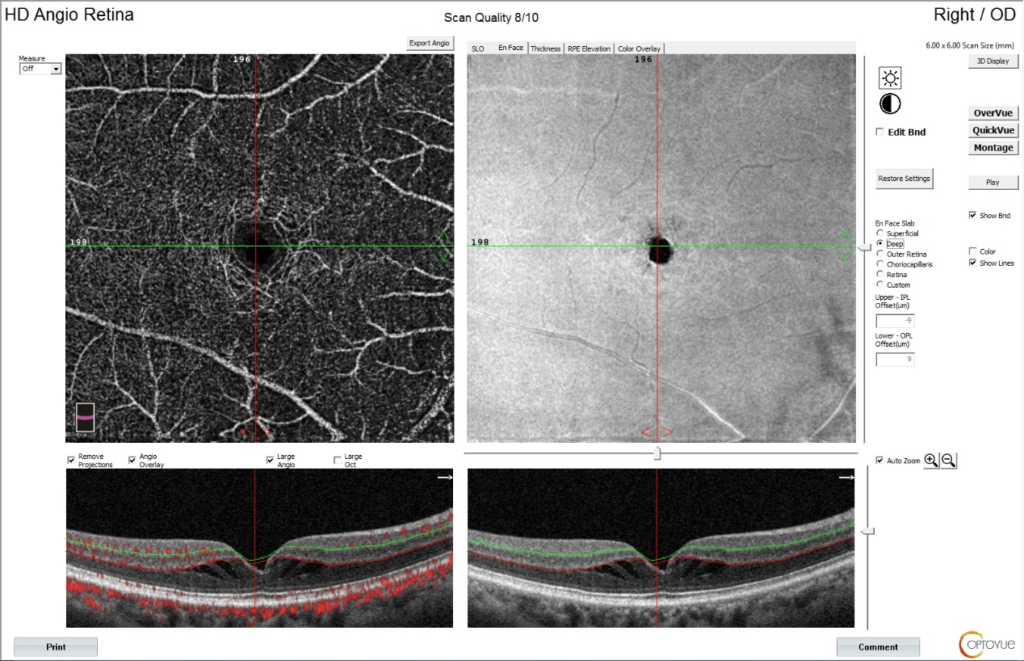 optical coherence tomography angiography