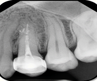 Intraoral periapical radiograph