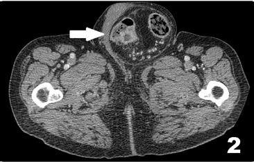 TC scan: tumor