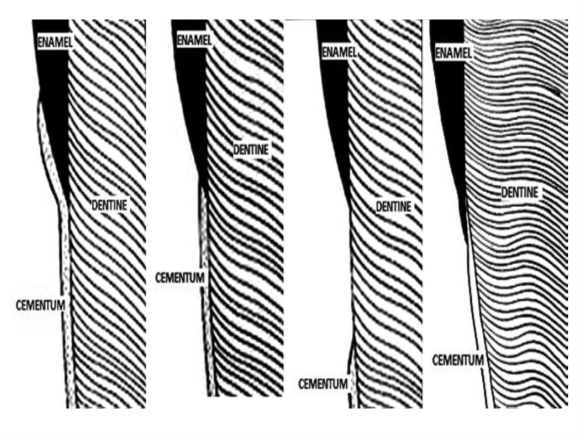 cervical enamel-cementum