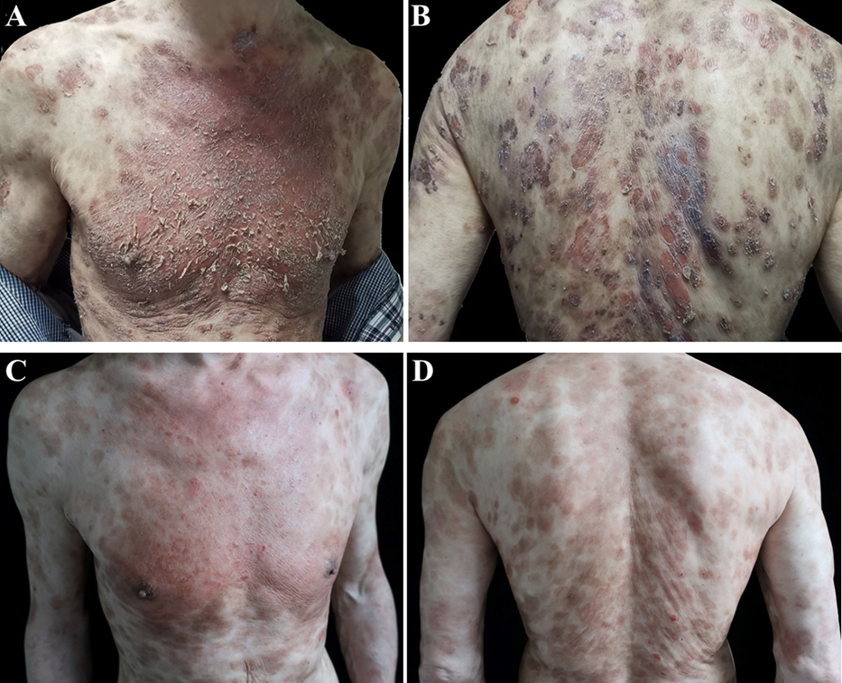 Extensive erythematous plaques