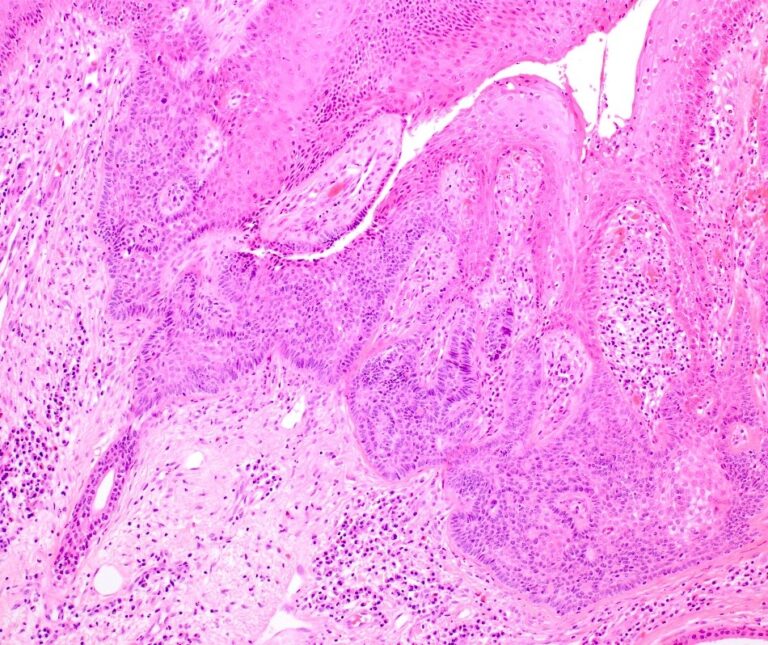 A Naevus Sebaceous with Tumour of the Follicular Infundibulum ...