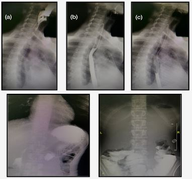 Barium swallow studies