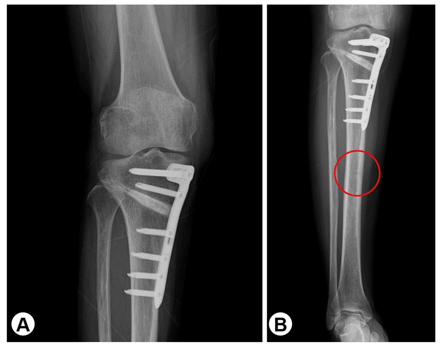 Medial Open-wedge High Tibial Osteotomy