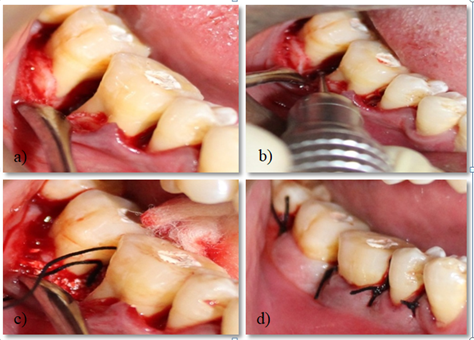 Intrabony defect