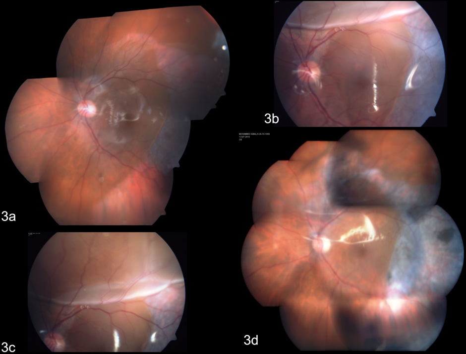 retinal fluid; retina under silicone oil