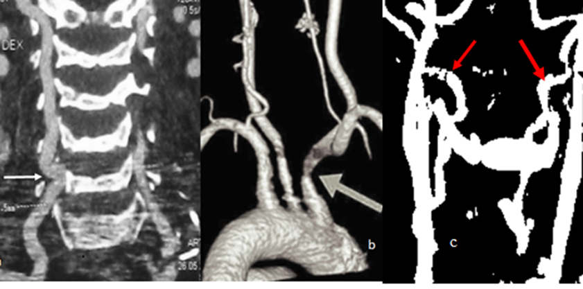 cervical vertebral bodies