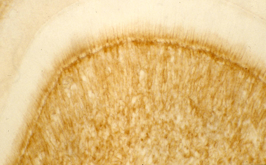 Collagenase 3 (Stromelysin 1).