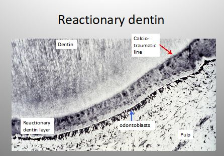 Reactionary dentin