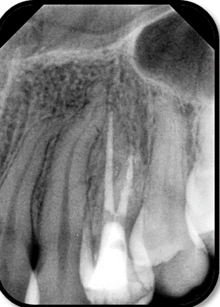 completed root canal treatment for tooth