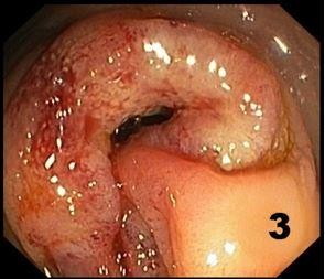 Colonoscopy: neoplastic stenosis