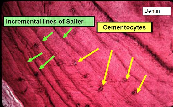 mixed cellular cementum